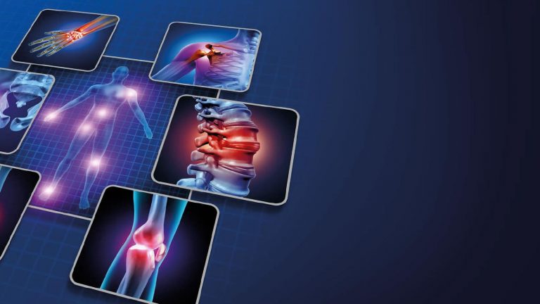 Spondyloarthritis, DISH and osteoarthritis: similarities and differences. Tentative schedules