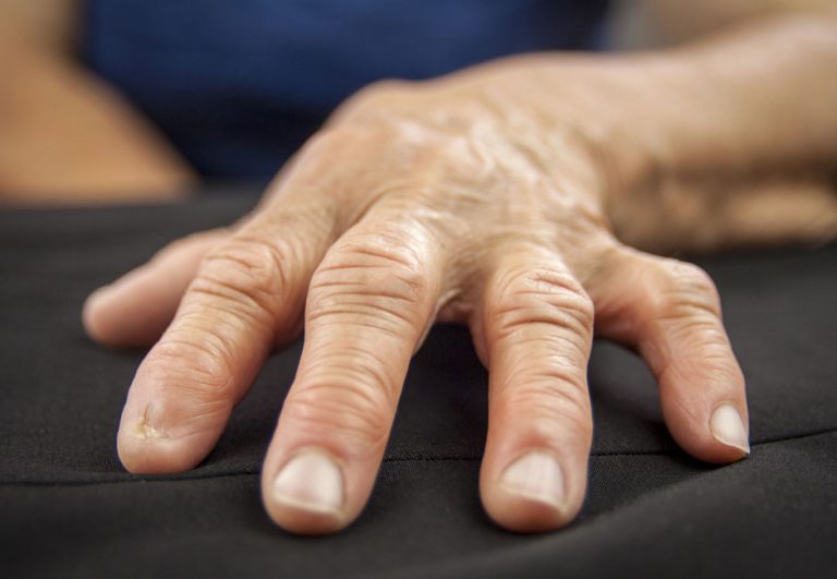 Artrite reumatoide: “la scelta della terapia non dipende dalla spesa per i farmaci, ma dall’esigenza del singolo paziente”